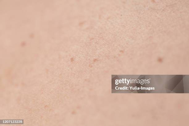 close up of brown mole on surface of human skin - mélanome photos et images de collection
