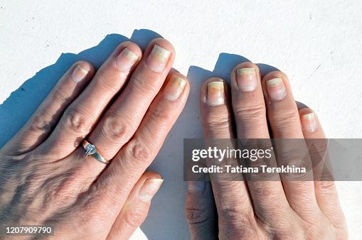 Shellac Gi Fungal Nail Infection Onycholysis After Shellac Or Gelvarnish Isolated ...