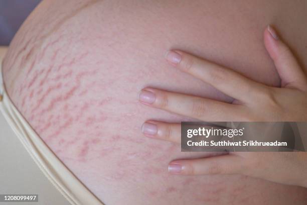 midsection of pregnant woman with stretch marks - stretch mark stock pictures, royalty-free photos & images