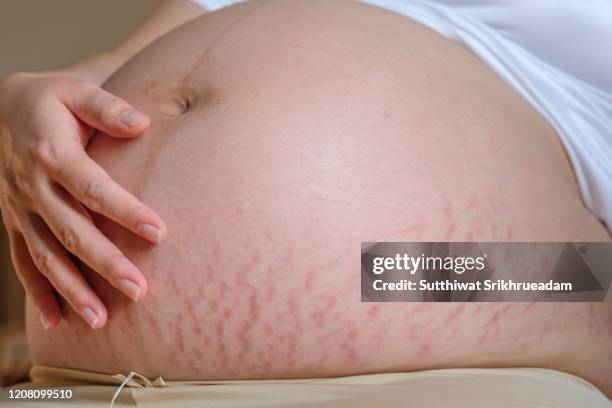 midsection of pregnant woman with stretch marks - stretch mark stock pictures, royalty-free photos & images