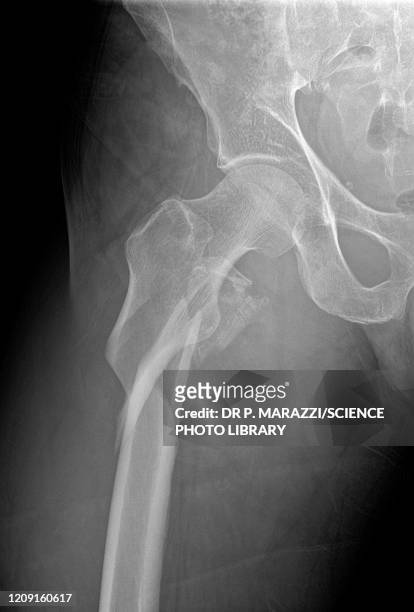 hip fracture, x-ray - comminuted fracture stock pictures, royalty-free photos & images