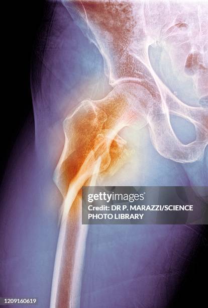 hip fracture, x-ray - knochenbruch stock-fotos und bilder