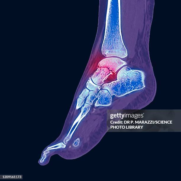 fractured ankle bone, ct scan - bone scan stock pictures, royalty-free photos & images