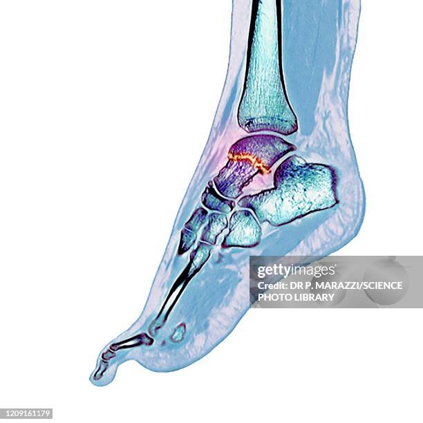 fractured ankle bone, ct scan - bone scan stock pictures, royalty-free photos & images