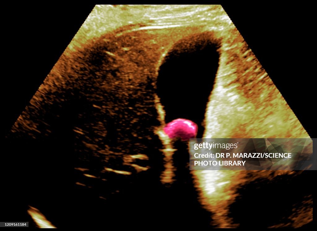 Gallstone, ultrasound scan