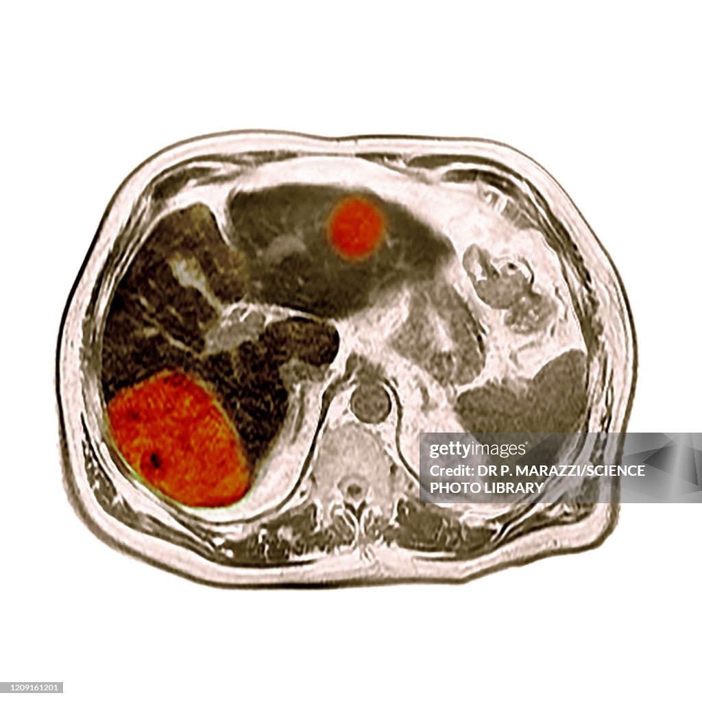 Liver cancer, CT scan