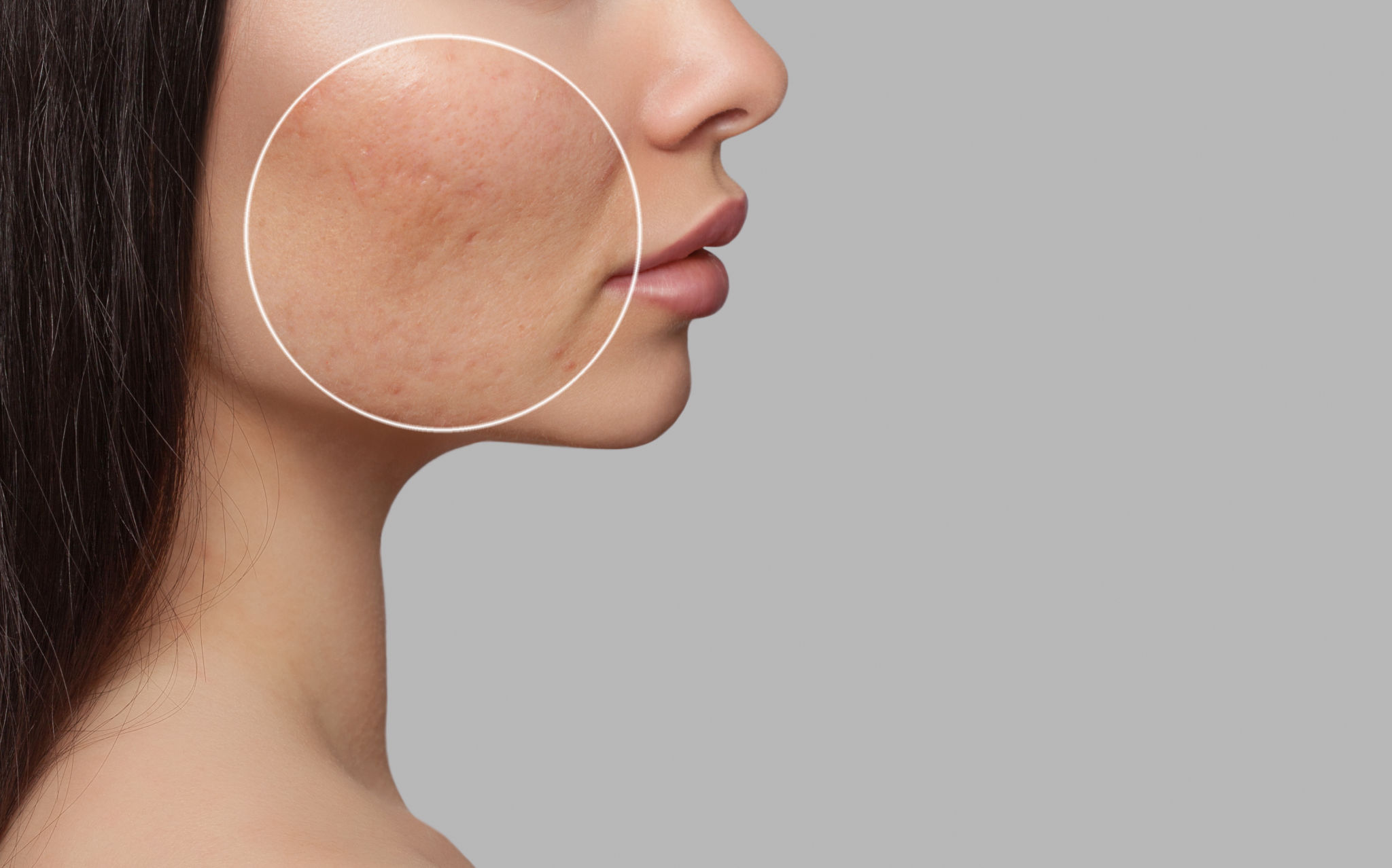 pore treatment