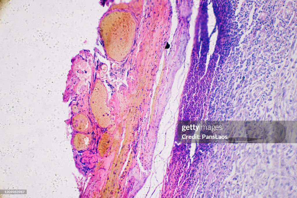 Micrograph of Melanoma cancer cells of human