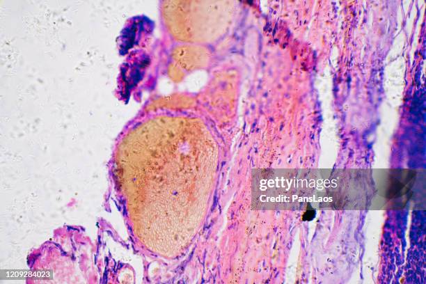 melanoma cancer cells of human under microscope - cancer cell stock pictures, royalty-free photos & images