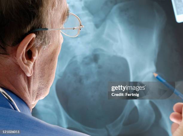 doctor examinar la osteoporosis en una radiografía. - osteoartritis fotografías e imágenes de stock