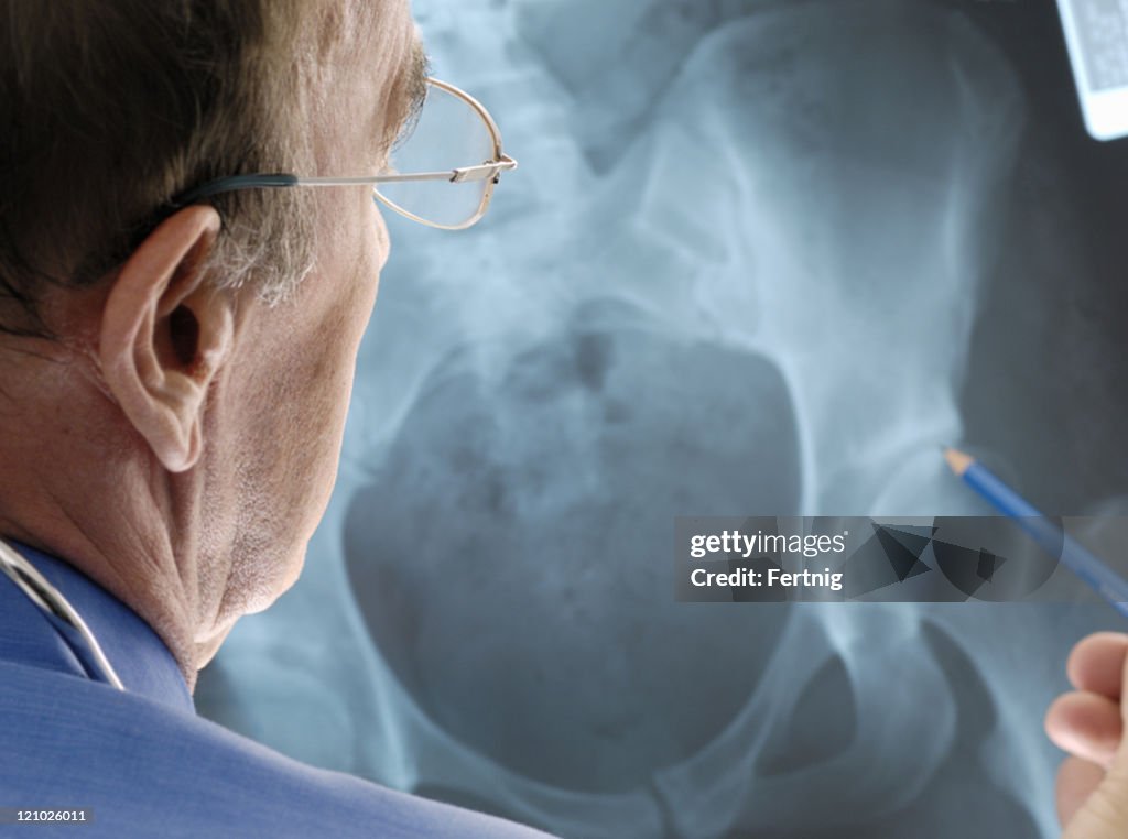 Doctor examining osteoporosis on an x-ray.