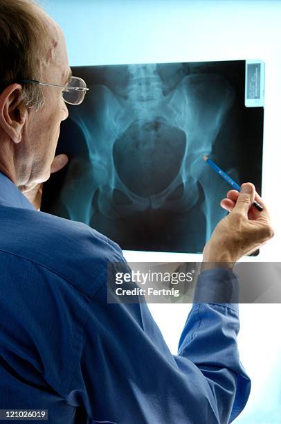 doctor examining an x-ray of pelvic region - male crotch stock pictures, royalty-free photos & images