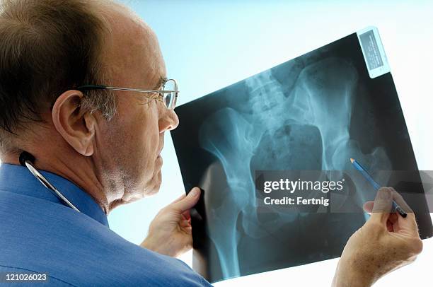 orthopaedic surgeon consulting pelvic x-rays for a hip replacement. - underliv bildbanksfoton och bilder