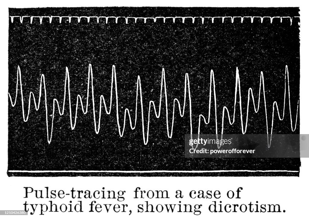 Dicrotic Pulse-Trace from a Sphygmograph of a Patient with Typhoid Fever - 19th Century