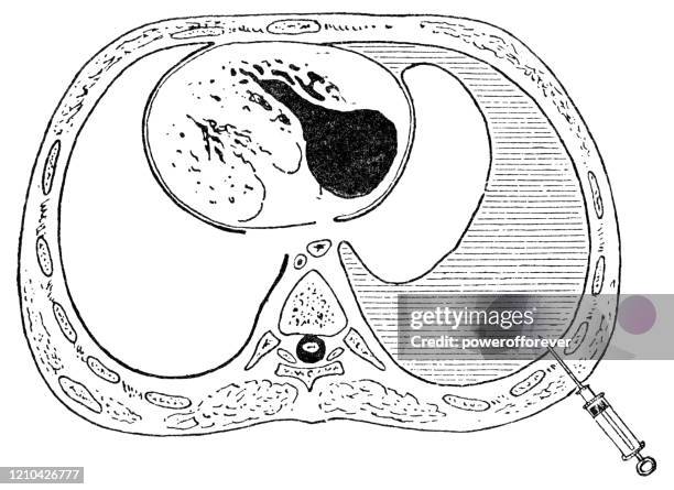 medical cross-section diagram showing a thoracentesis procedure - 19th century - pleural cavity stock illustrations