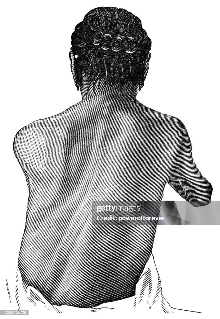 Patient With Pleurisy - 19th Century
