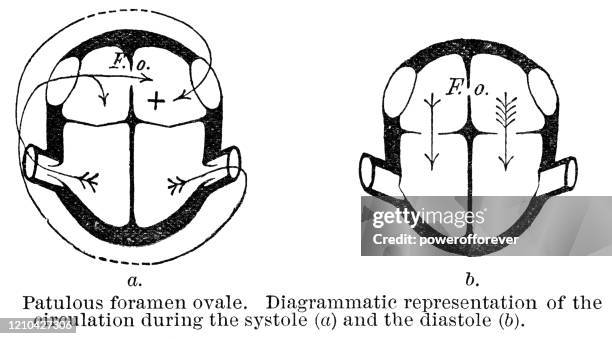 bildbanksillustrationer, clip art samt tecknat material och ikoner med medicinska diagram som visar patientens hjärtfunktion med patentforamen oval - 1800-talet - heart ventricle