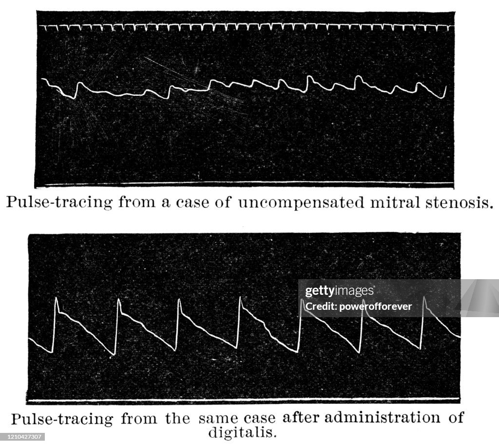 Mitral Stenosis Heart Disease Pulse-Trace from a Sphygmograph, Before and After Treatment With Foxglove - 19th Century
