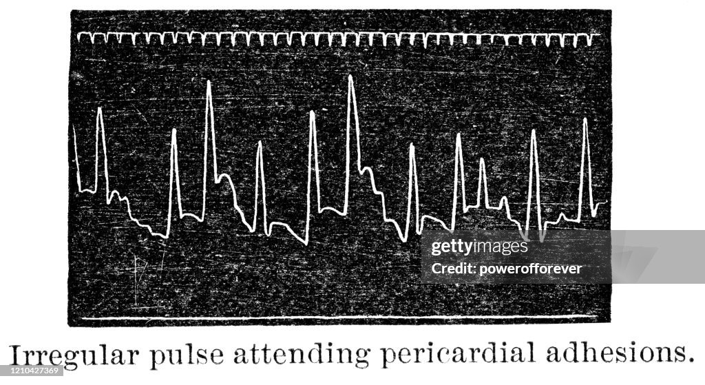 Pulse-Trace from a Sphygmograph of Patient With Pericardial Adhesions - 19th Century