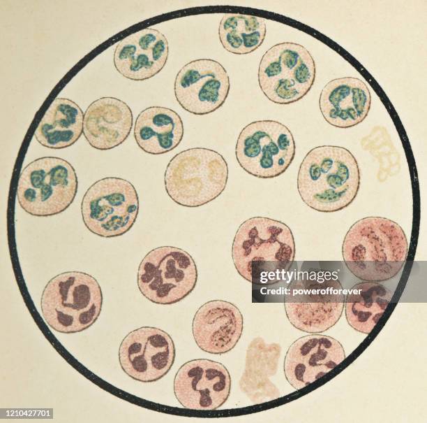 stockillustraties, clipart, cartoons en iconen met microscopische weergave van multinucleated menselijke witte bloedcellen - 19e eeuw - hematoxylin and eosin staining