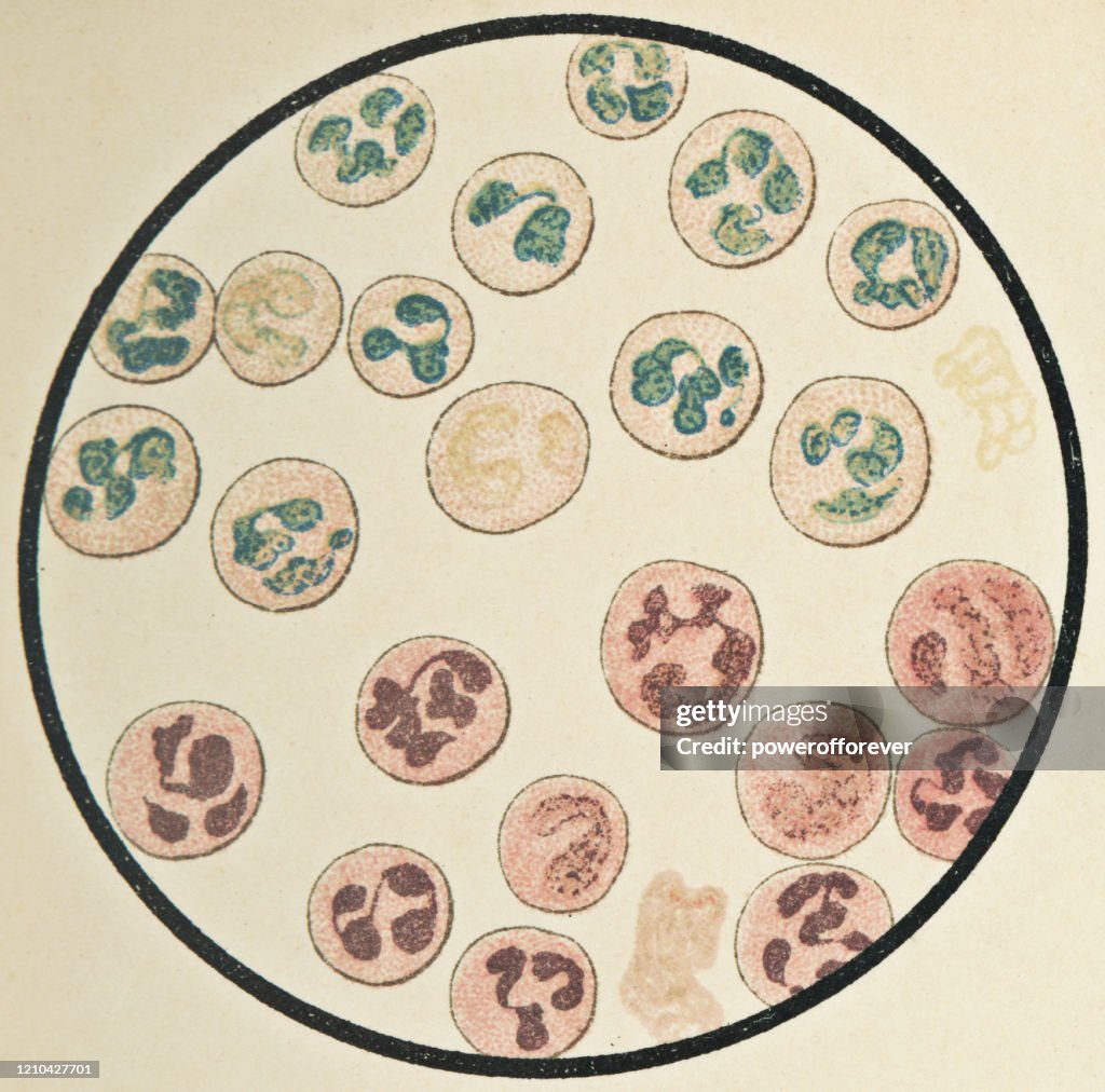 Microscopic View of Multinucleated Human White Blood Cells - 19th Century