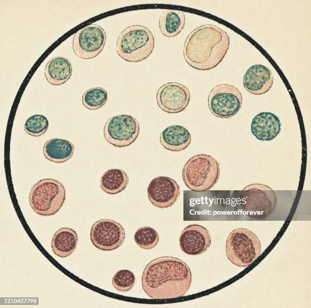ヒト白血球の顕微鏡的見解 - 19世紀 - ヘマトキシリンエオジン染色点のイラスト素材／クリップアート素材／マンガ素材／アイコン素材