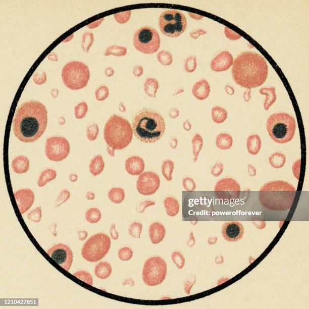 粘性貧血患者からのヒト赤血球のポイキロサイトスの顕微鏡的見解 - 19世紀 - ヘマトキシリンエオジン染色点のイラスト素材／クリップアート素材／マンガ素材／アイコン素材
