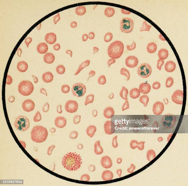 深い貧血患者からのヒト赤血球のポイキロサイトスの顕微鏡的見解 - 19世紀 - ヘマトキシリンエオジン染色点のイラスト素材／クリップアート素材／マンガ素材／アイコン素材