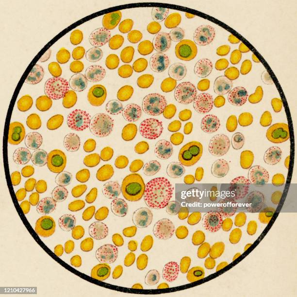 microscopic view of human blood cells from a patient with chronic myelogenous leukemia, stained with ehrlich triacid stain - 19th century - cml stock illustrations