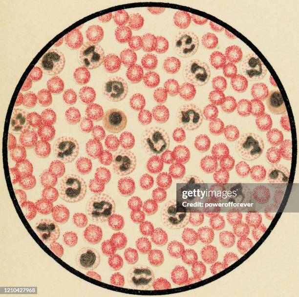 肺炎患者からのヒト血液細胞の白血球症の顕微鏡的見解- 19世紀 - ヘマトキシリンエオジン染色点のイラスト素材／クリップアート素材／マンガ素材／アイコン素材