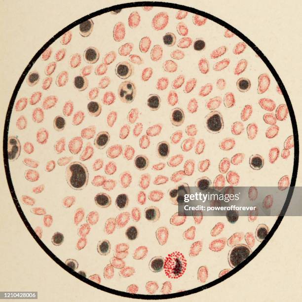 リンパ性白血病患者からのヒト血液細胞の顕微鏡的な見解、ヘマトキシリンとエオシンで染色 - 19世紀 - ヘマトキシリンエオジン染色点のイラスト素材／クリップアート素材／マンガ素材／アイコン素材