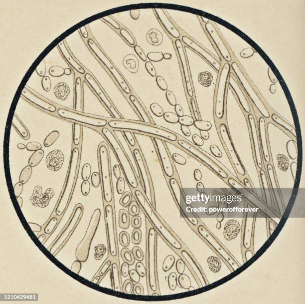 microscopic view of candida albicans from a patient with mycosis - 19th century - anatomy charts stock illustrations