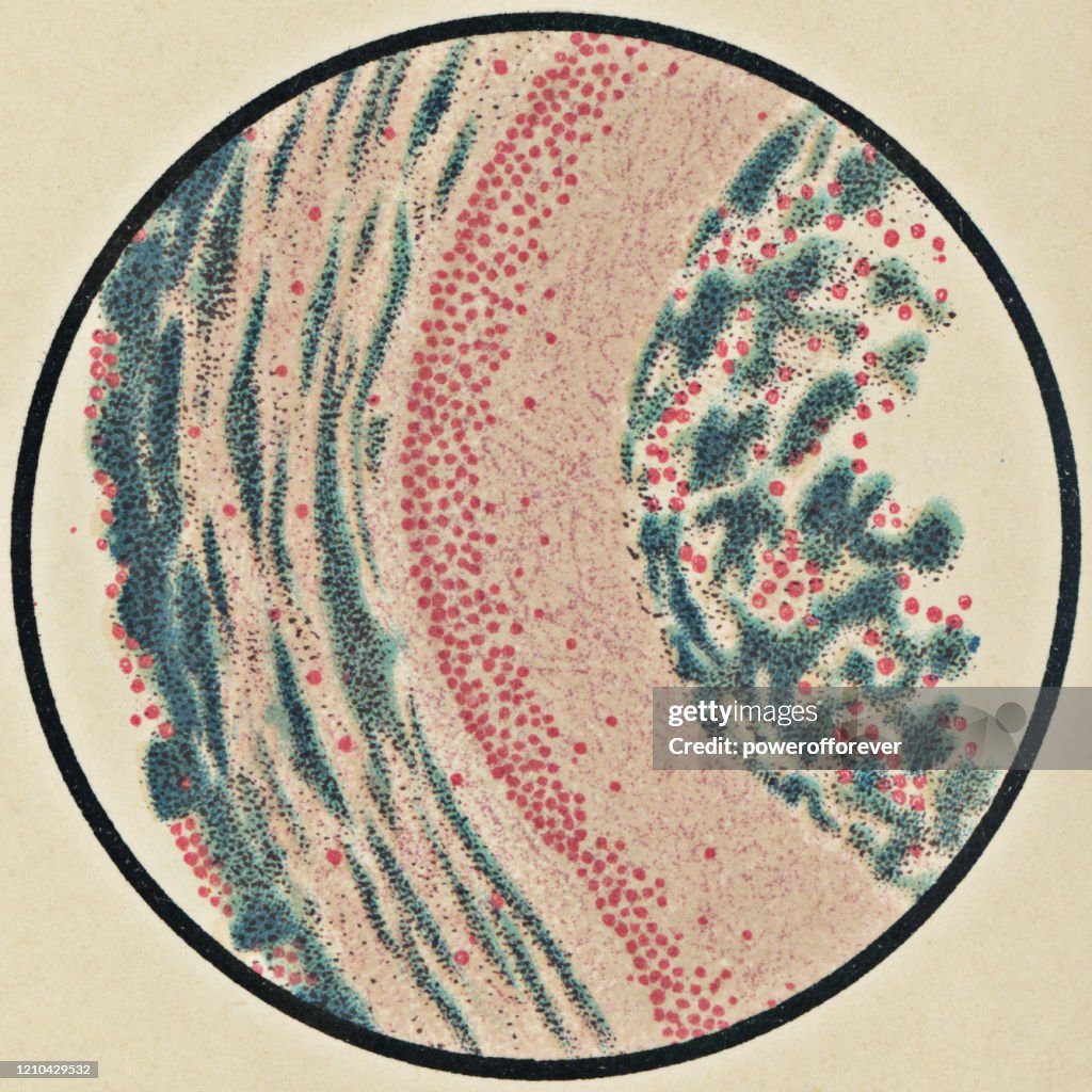 Microscopic View of a Pseudomembrane from a Patient with Diphtheria, Stained with Carmine and Methylene Blue - 19th Century