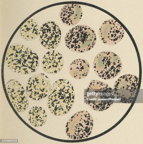 illustrazioni stock, clip art, cartoni animati e icone di tendenza di vista microscopica delle cellule macrofagi alveolari, lato sinistro macchiato di blu di metilene - xix secolo - macrofago