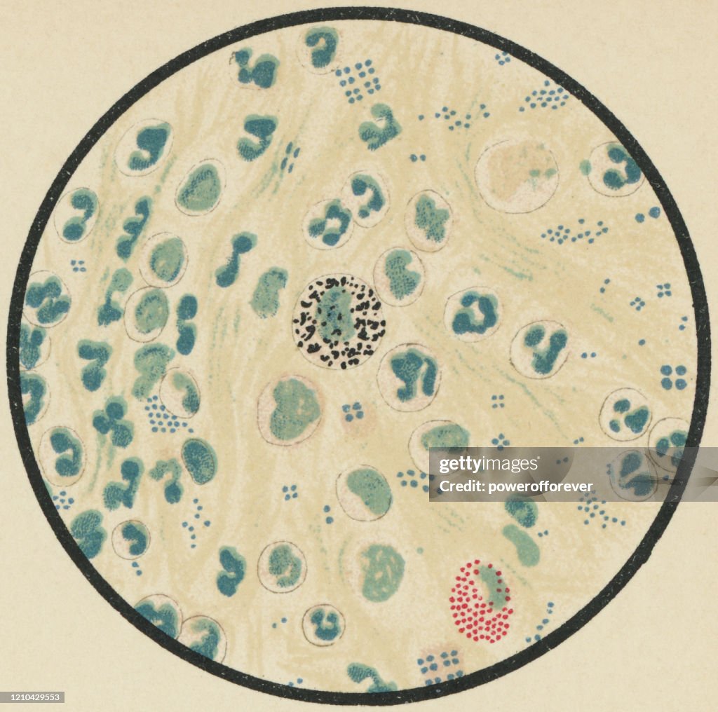 Vista microscópica de células y bacterias humanas en el moco de esputo, manchado con azul de metileno y eosina - siglo XIX