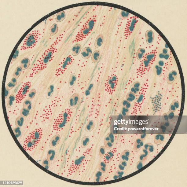 illustrations, cliparts, dessins animés et icônes de vue microscopique des éosinophiles et des microcoques dans le mucus de spéléo d’un patient avec l’asthme, taché avec le bleu de méthylène et l’éosine - 19ème siècle - planche médicale