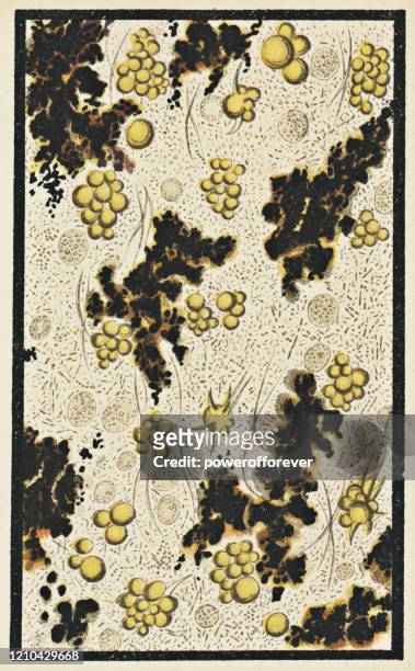 ilustraciones, imágenes clip art, dibujos animados e iconos de stock de vista microscópica del moco de esputo de un paciente con gangrena pulmonar - siglo xix - gangrena
