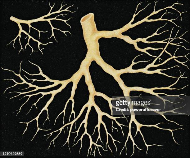 microscopic view of fibrinous blood clot of a bronchiole tree from a patient with diphtheria - 19th century - diphtheria stock illustrations