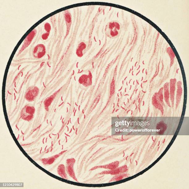 microscopic view of vibrio cholerae bacteria from a patient with cholera - 19th century - acid fast stain stock illustrations