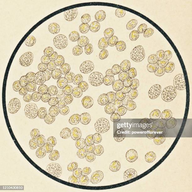 microscopic view of human neutrophil cells from pus - 19th century - phagocyte stock illustrations