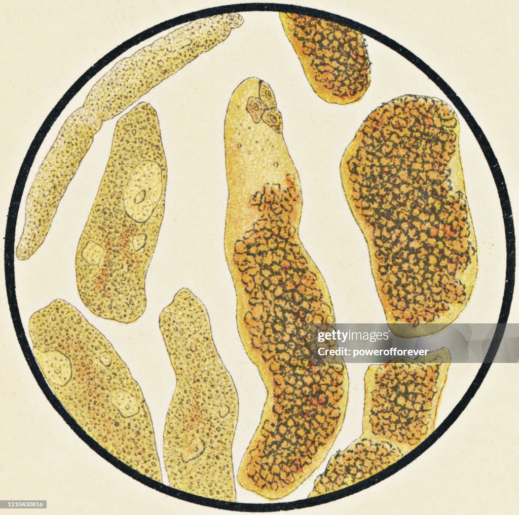 Microscopic View of Human Granular Urinary Casts from a Patient with Kidney Disease - 19th Century