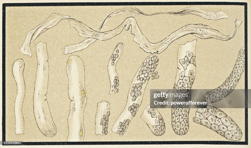 Microscopic View of Human Urinary Casts from the Kidney - 19th Century