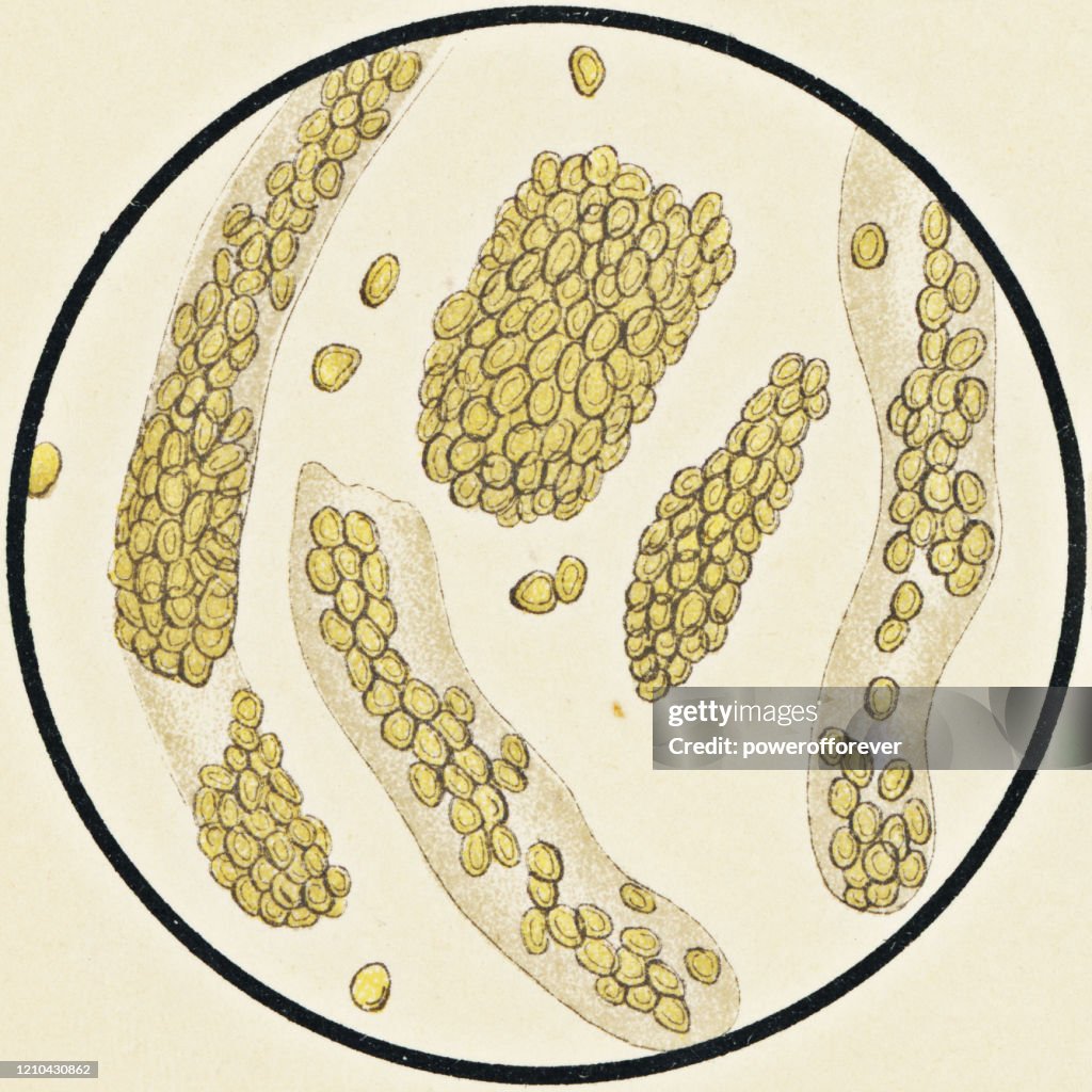 Microscopic View of Human Red Blood Cell Urinary Casts from a Patient with Nephritis - 19th Century