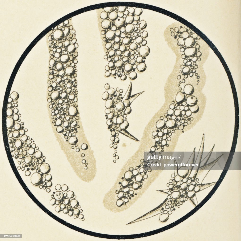 Microscopic View of Human Fatty Urinary Casts from a Patient with Nephrotic Syndrome - 19th Century