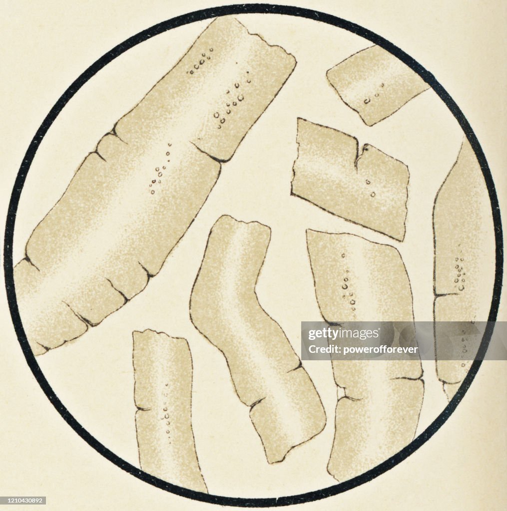 Microscopic View of Human Waxy Urinary Casts from a Patient with Nephrotic Syndrome - 19th Century