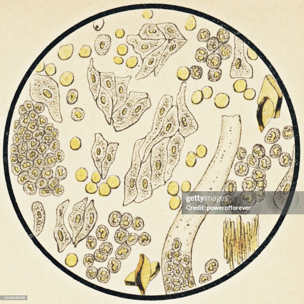 Microscopic View of Human Urinary Sediment from a Patient with Pyelonephritis - 19th Century