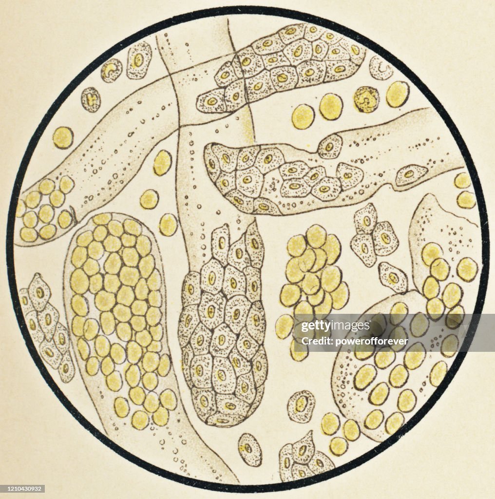 Microscopic View of Human Urinary Sediment from a Patient with Hemorrhagic Nephritis - 19th Century