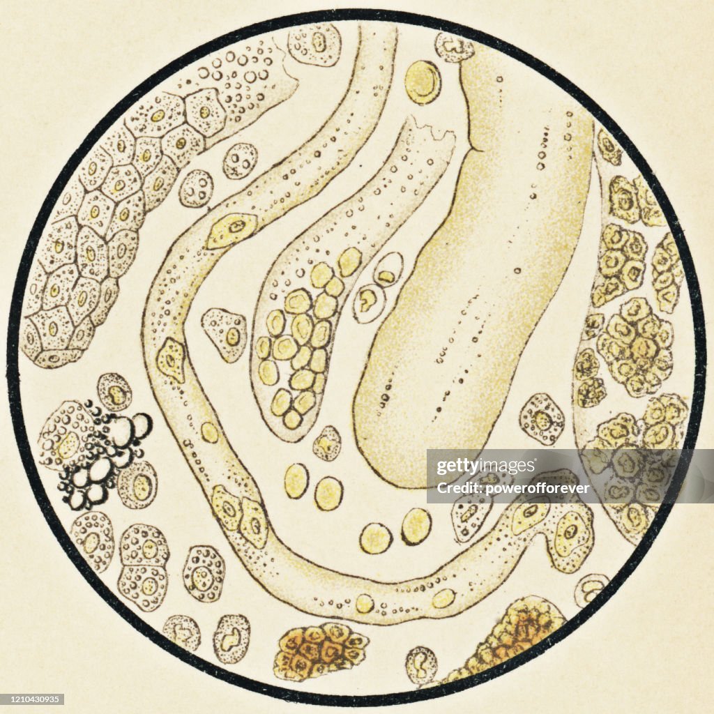 Microscopic View of Human Urinary Sediment from a Patient Recovering from Hemorrhagic Nephritis - 19th Century
