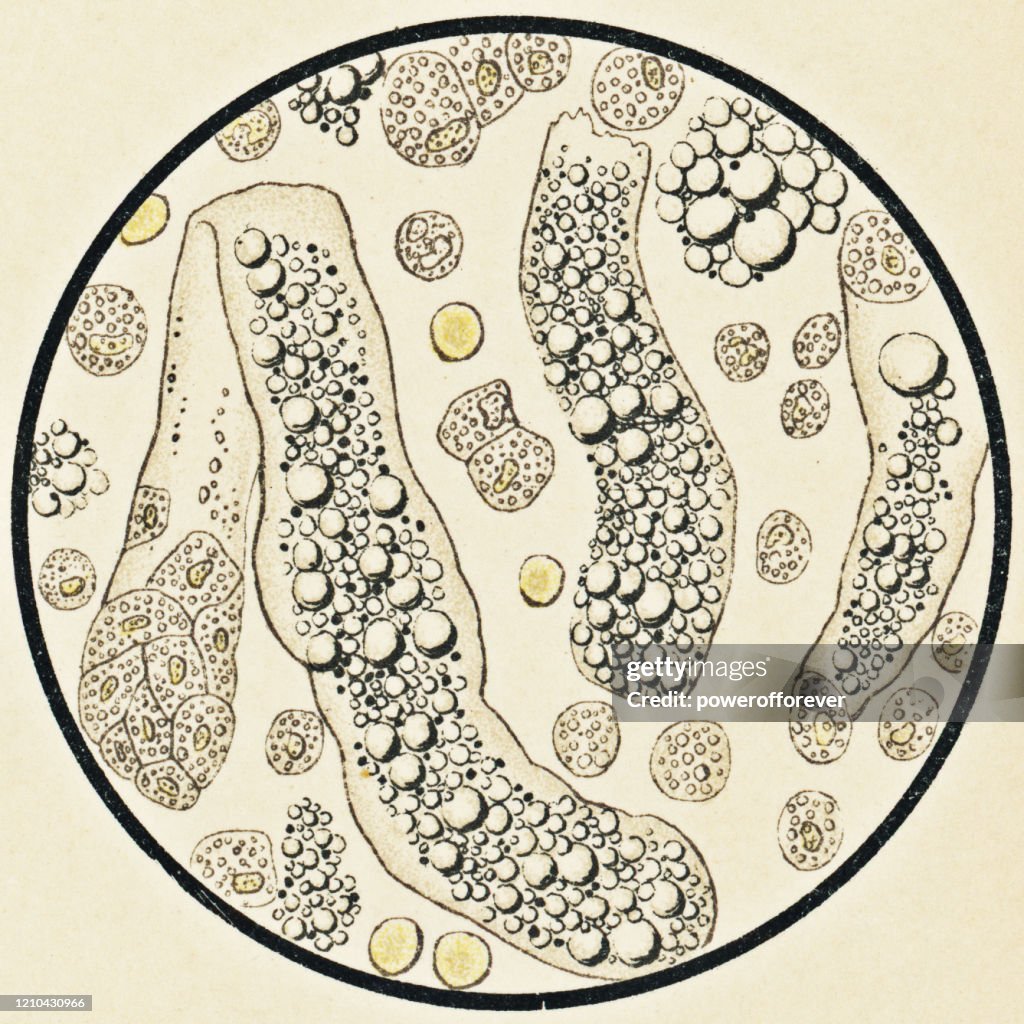 Microscopische weergave van menselijk urinesediment van een patiënt met nefritisch syndroom - 19e eeuw