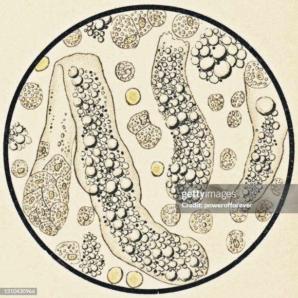 microscopic view of human urinary sediment from a patient with nephritic syndrome - 19th century - urine sample stock illustrations